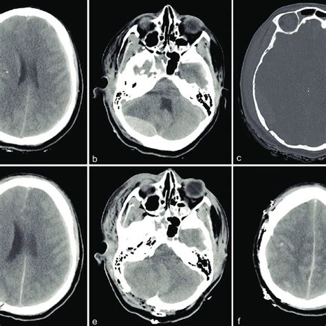 Preoperative Noncontrast Ct Head Scans Show A Right Temporal Epidural