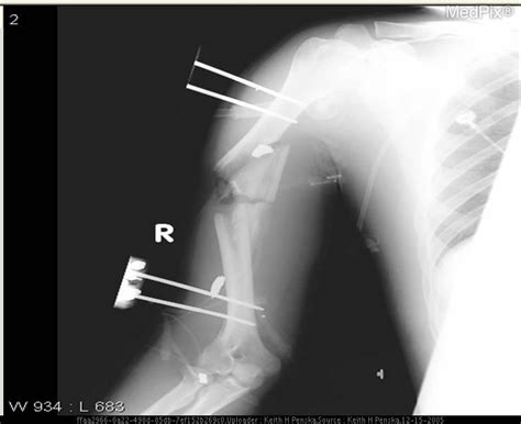 Comminuted Fracture