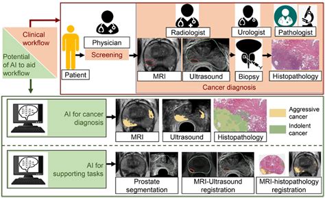 Potential Of Ai To Assist Prostate Cancer Diagnosis On Imaging Ai