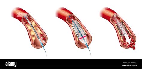 Medical Illustration Showing Balloon Angioplasty And Stent Insertion