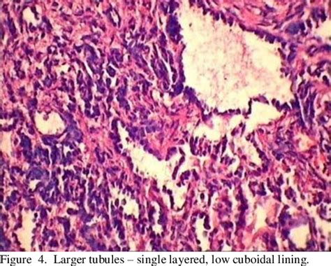 Figure 1 From Retiform Variant Of Sertoli Leydig Cell Tumor A Rare