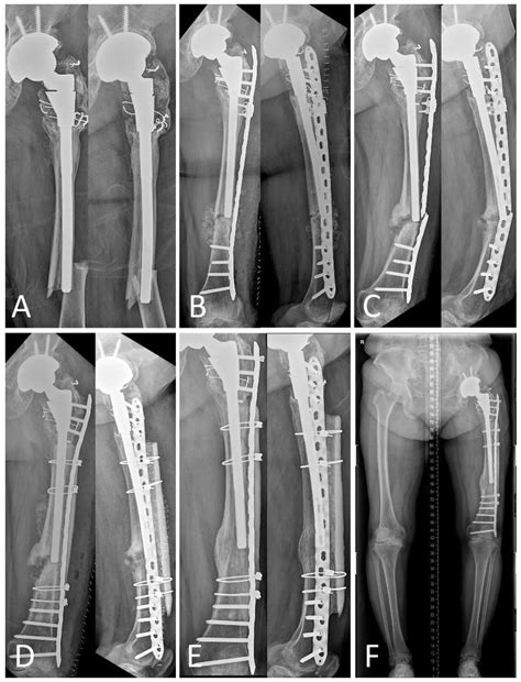 Femur Fracture Plate