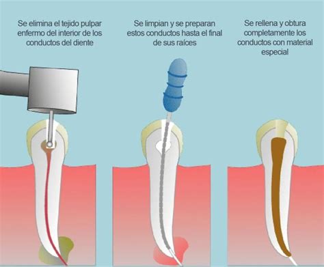 Endodoncia Dental