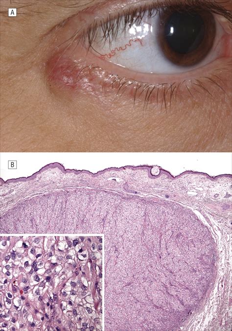 Metastatic Tumors To The Eyelid Report Of 20 Cases And Review Of The Literature Oncology