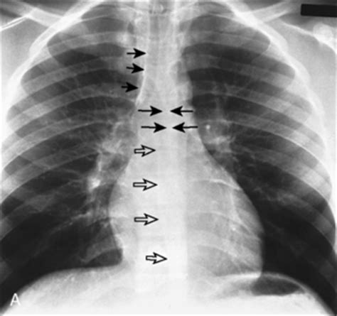 The Mediastinum: Anatomy | Radiology Key