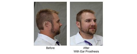 Auricular (Ear) Prosthesis for Osseointegrated Ear Implant | Custom ...