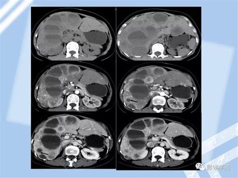 22種肝臟少見及不典型腫瘤的影像表現 每日頭條