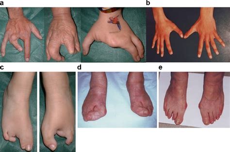 Clinical Genetic And Molecular Aspects Of Split‐handfoot