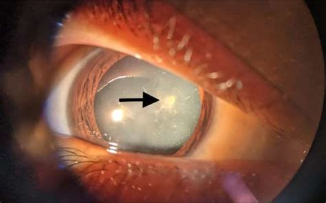 Figure 1 from Snowflake cataract in Down’s syndrome | Semantic Scholar