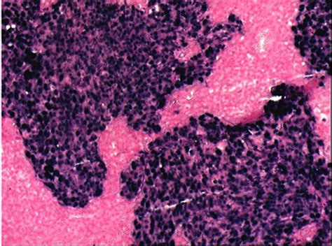 Diffuse Nuclear Eber In Situ Hybridization Positivity Supporting Download Scientific Diagram