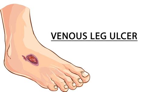 Pictures Of Venous Stasis Ulcers On Lower Leg