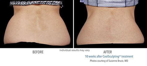 Coolsculpting Before And After Images Real Patient Results