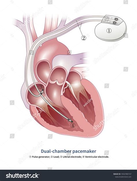 Dual Chamber Pacemaker Can Sense Pace Stock Illustration 1953780157