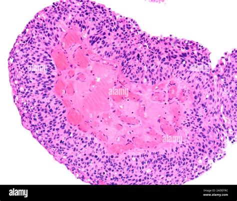 Micrografía de luz de alto grado carcinoma urotelial papilar también