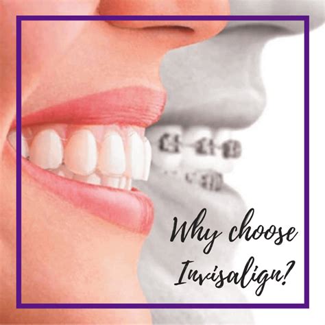 Benefits Of Invisalign Vs Braces