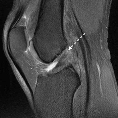 Reparação ou Reinserção do Ligamento Cruzado Anterior Dr Fabiano Kupczik