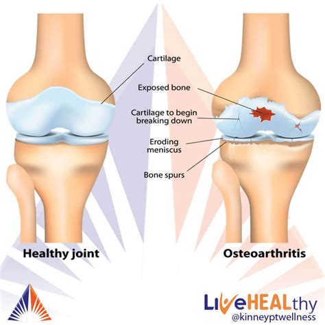 What Is Osteoarthritis Kinney Physical Therapy Wellness