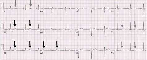 The Non-Specific T wave abnormality | Resus