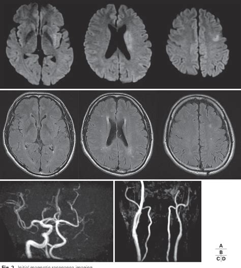 Figure 2 From A Case Of Internal Carotid Artery Occlusion And Middle