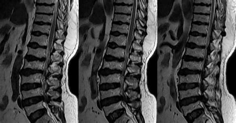 Neuroradiology Cases Scheuermann S Disease Mri