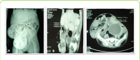 Figure 2 From Giant Umbilical Hernia In A Patient With Hurler S Syndrome Case Report