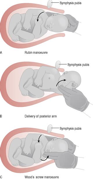 Shoulder Dystocia Woods Screw Maneuver