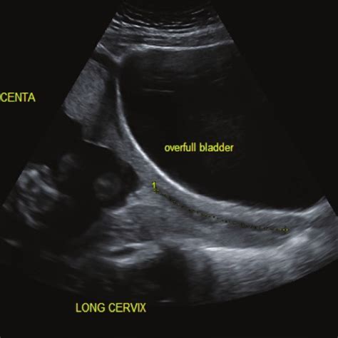 Pdf Cervical Length Measurement Comparison Of Transabdominal