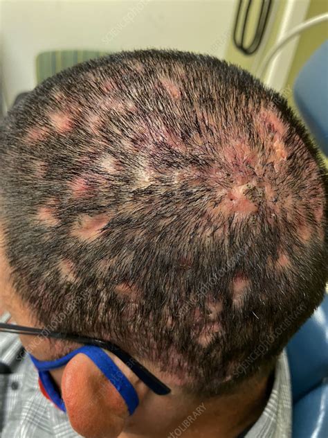 Scalp Cellulitis