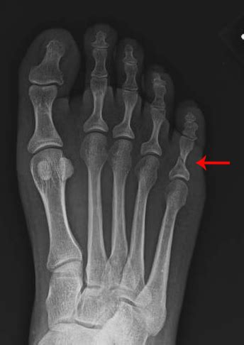 Middle Phalanx Fracture Toe