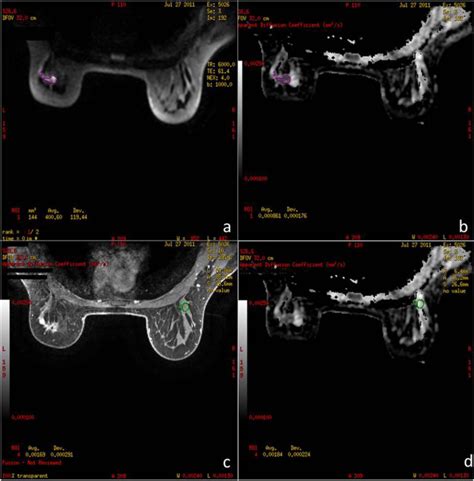 Impact Of Fibroglandular Tissue And Background Parenchymal Enhancement