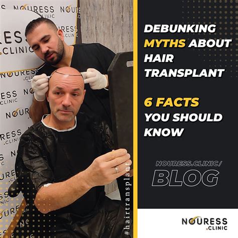 Debunking Myths About Hair Transplants 6 Facts You Should Know