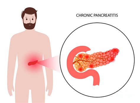 Chronic Pancreatitis Symptoms