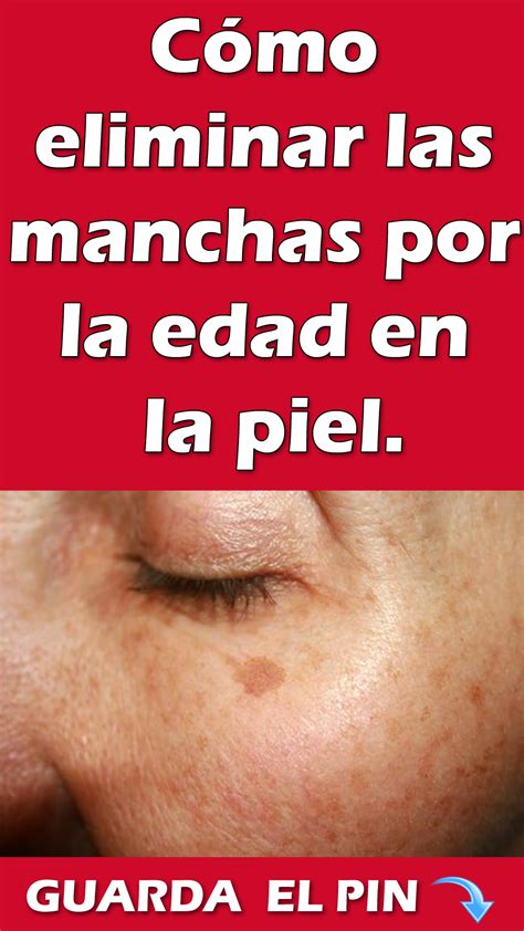 Cómo Eliminar Las Manchas Por La Edad En La Piel Manchas En La Cara Manchas Oscuras En La