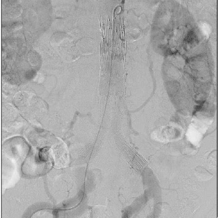 Angiographic Finding Of A Type Ii Endoleak The Aneurysmal Sac Was