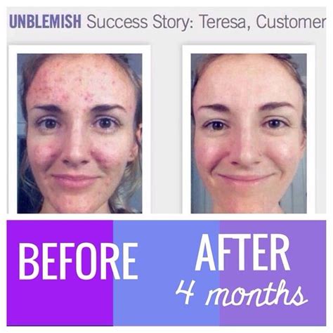 Unblemish Skin And Rid Acne For Good Rodan And Fields Unblemish