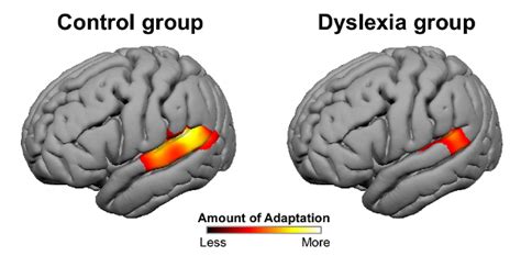 Dyslexia And The Brain A Problem With Rapid Neural Adaptation