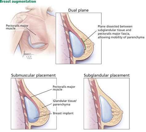 Breast augmentation surgery: Clinical considerations | MDedge