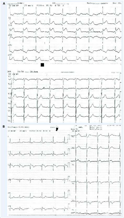 A Electrocardiogram On Admission Revealed Q Wave At Leads Ii Iii Avf
