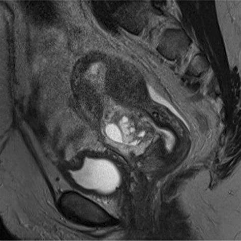 Pdf Cesarean Section Scar Ectopic Pregnancy A Management Conundrum