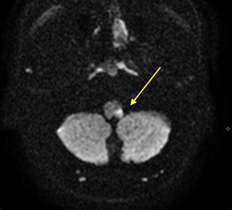 Lateral Pontine Syndrome Mri