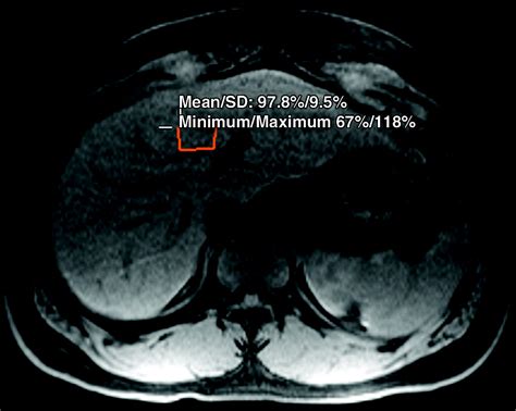 MRI Arterial Enhancement Fraction In Hepatic Fibrosis And Cirrhosis AJR