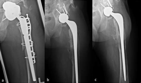 A Pre Operative Anteroposterior Ap Radiograph Showing A Modular