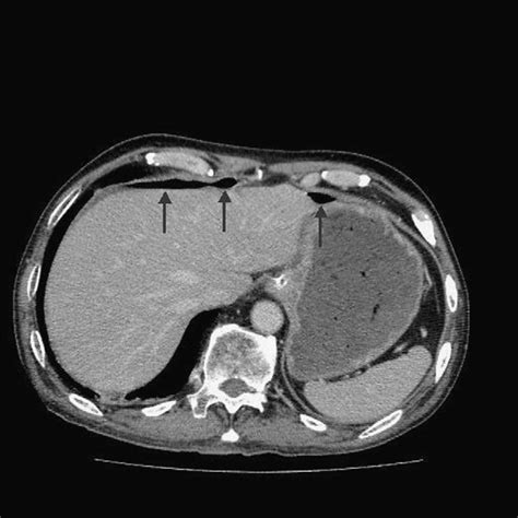 Supine Abdominal Radiograph Showing Minimal Left Subphrenic Free Air Download Scientific