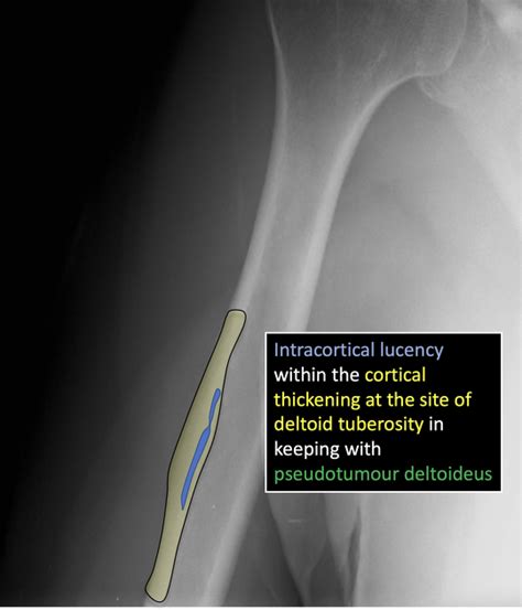 Deltoid Tuberosity X Ray