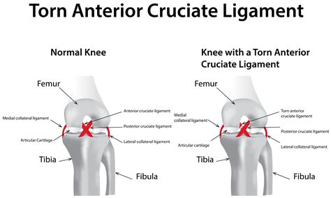 Meniscal Injuries | Physica