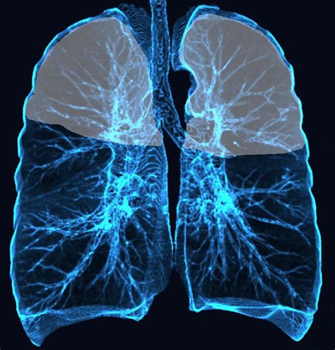 Upper Lobes And Centrilobular Emphysema Lungs