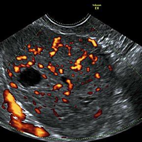 (PDF) Imaging in endometrial cancer