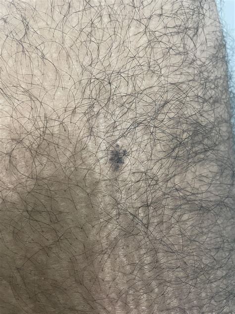 Is this a Nevus Spilus on my Upper Thigh? Been there a while I think
