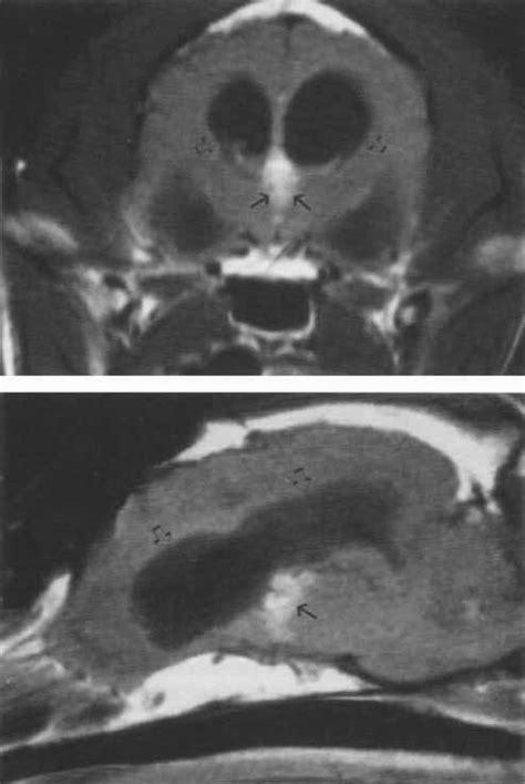 Transverse A And Sagittal B T Weighted Mr Images After Gd Dtpa