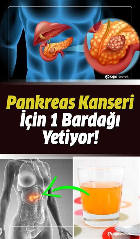 Pankreas Kanseri Belirtileri Evreleri Tedavisi Ameliyat Sara O Lu K R